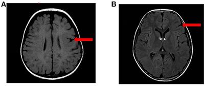 Clinical phenotypic and genotypic characterization of NPRL3-related epilepsy